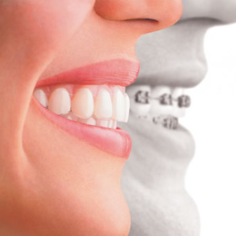Diş Teli Tedavisi
